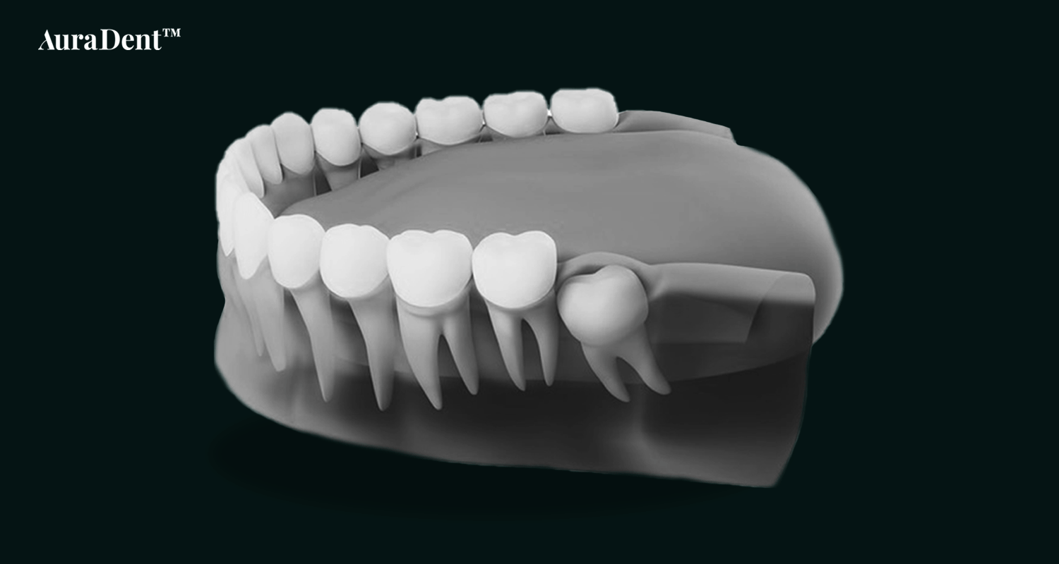 Denna bild visar ett Retinerade tänder, ett vanligt bettproblem som kan behandlas med Invisalign.